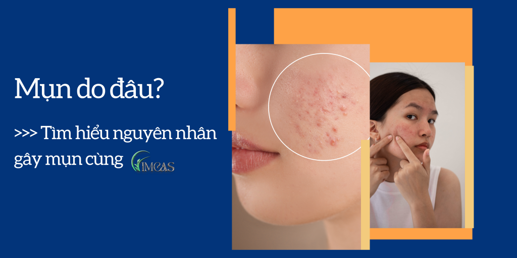 Nguyên nhân mụn do đâu? Tìm hiểu ngay cách trị mụn cùng IMCAS Spa